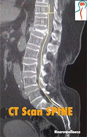 CT Spine