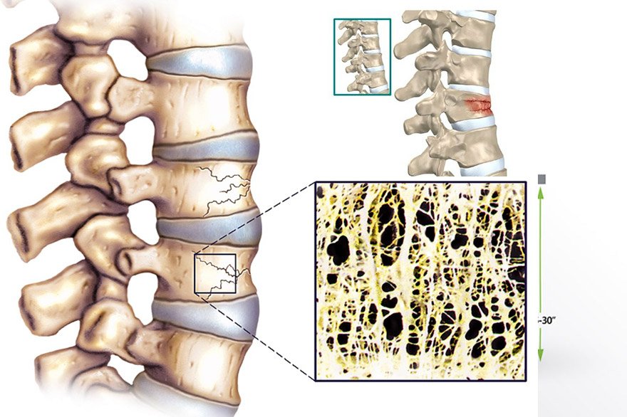 Osteoporosis-banner