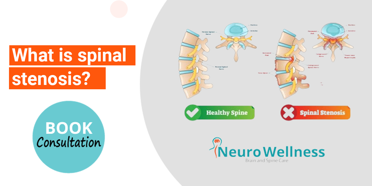 spinal stenosis