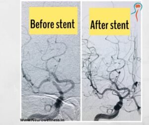 Stenting