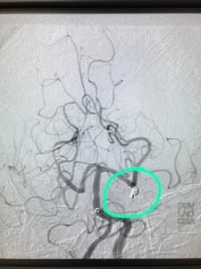 COIL IN SITU ANEURYSM POST-PROCEDURE

