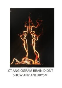 CT Angiogram Brain Didnt Show Any Aneurysm