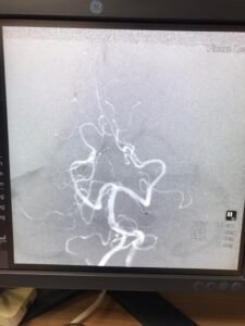 DSA POST COILING SHOWING LEFT SCA OCCLUDED- microcatheter in place

