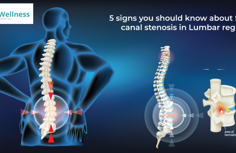 Spinal canal stenosis in Lumbar region