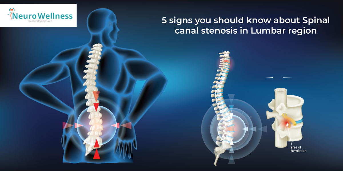 Spinal canal stenosis in Lumbar region