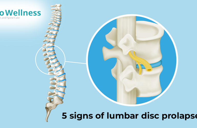 lumbar disc prolapse