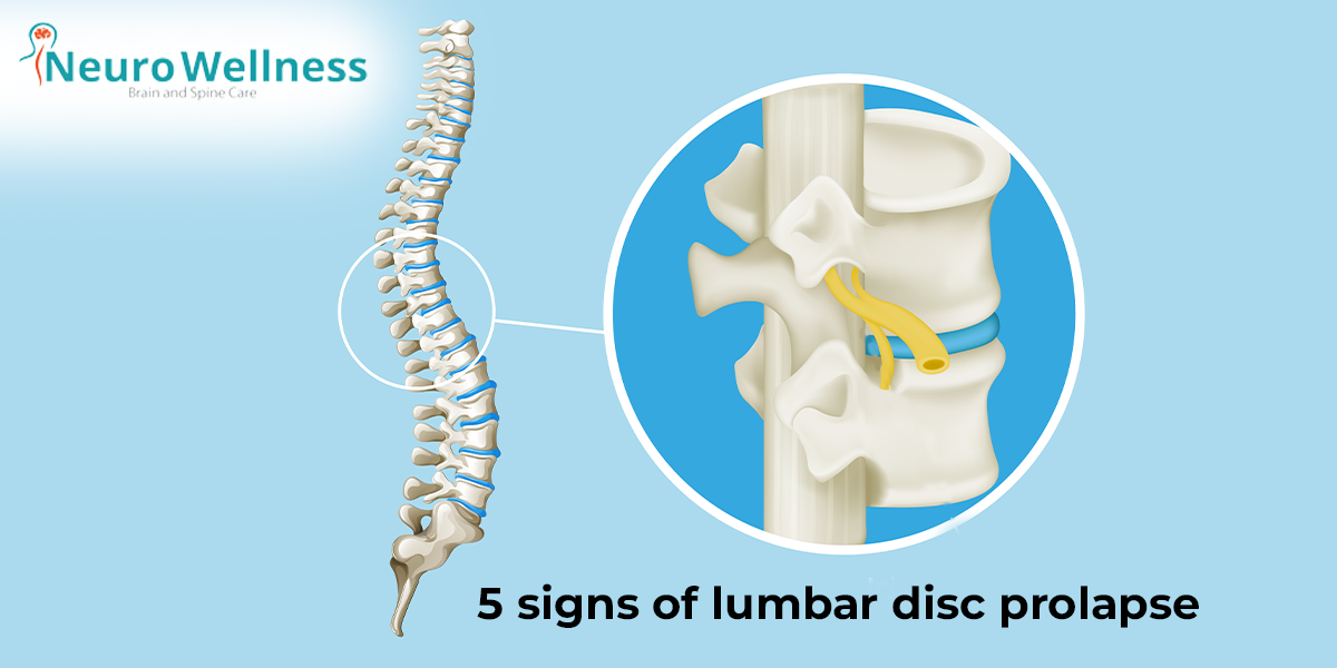 lumbar disc prolapse